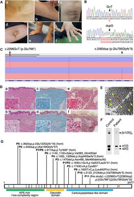 Case report: further delineation of AEBP1-related Ehlers–Danlos Syndrome (classical-like EDS type 2) in an additional patient and comprehensive clinical and molecular review of the literature